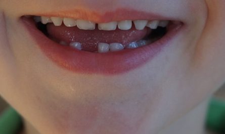 dreaming of missing teeth