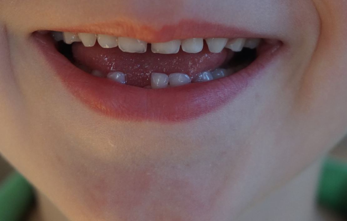 dreaming of missing teeth