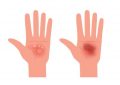 7 symbolic meanings of dreaming about blisters