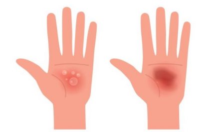 7 symbolic meanings of dreaming about blisters