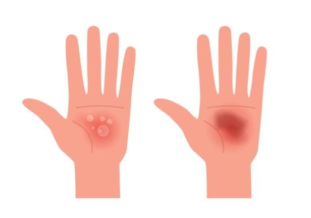 7 symbolic meanings of dreaming about blisters