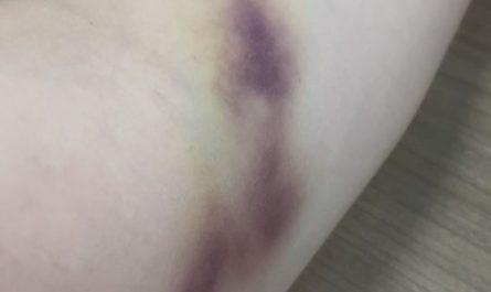 6 symbolic meanings of Dream about blood bruising