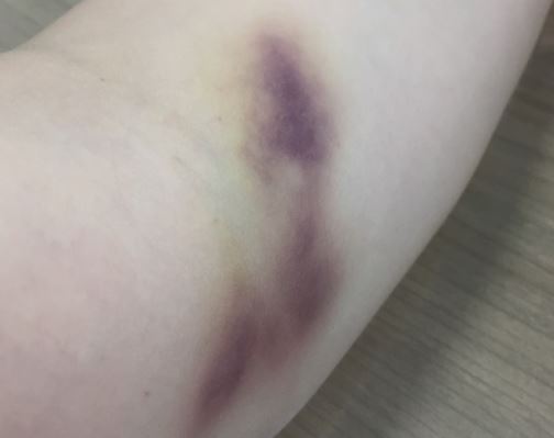 6 symbolic meanings of Dream about blood bruising