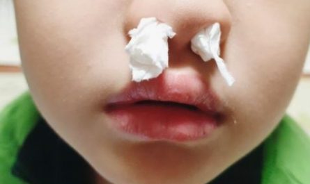 5 Spiritual Meanings of Dream about double nosebleeds