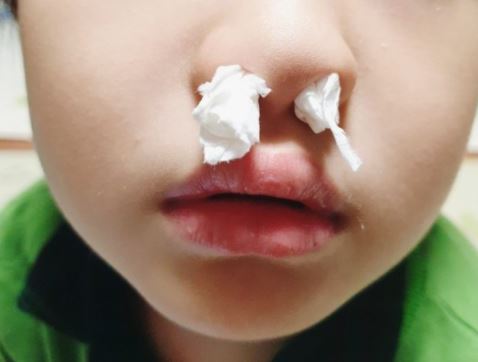 5 Spiritual Meanings of Dream about double nosebleeds